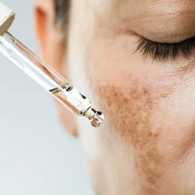 Melasma Treatment in Islamabad | ERCs
