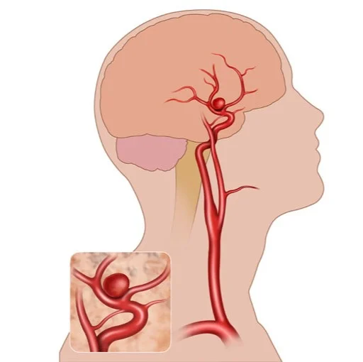 Coiling Surgery for Minimally Invasive Brain Aneurysm Treatment | IRFacilities